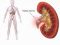 किडनी की पथरी का इलाज, अपनाएं ये 4 उपाय, निकल जाएगी किडनी की पथरी - Hindi News | Get Rid kidney stone naturally home remedies for dissolve kidney stone | Latest health Photos at Lokmatnews.in