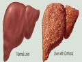 निर्देशक निशिकांत कामत Liver Cirrhosis से पीड़ित, जानिए लीवर सिरोसिस के कारण, लक्षण, बचने के उपाय - Hindi News | Bollywood director Nishikant Kamat hospitalised in Hyderabad with liver cirrhosis, what is liver cirrhosis, signs and symptoms, causes, risk factors, medical treatment and prevention tips of liver cirrhosis in Hindi | Latest health News at Lokmatnews.in