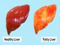लिवर खराब होने के शुरुआती लक्षण, जानें फैटी लिवर के कारण और इलाज - Hindi News | Fatty liver symptoms early sign fatty liver disease causes and treatment Liver disease | Latest health Photos at Lokmatnews.in