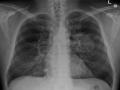 Lung cancer: मौत के खतरे को आधी कर सकती है लंग कैंसर की गोली, वैज्ञानिकों ने खोजी ये अचूक दावा!- अध्ययन - Hindi News | Lung cancer pill may half the risk of death says Study | Latest health News at Lokmatnews.in