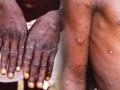 Mpox : नया वायरस, नई चिंताएं - Hindi News | Mpox monkeypox new virus with new concerns | Latest health News at Lokmatnews.in