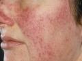 त्वचा रोग रोजेशिया का इलाज : चर्म रोग Rosacea के 4 लक्षण समझें, राहत पाने के लिए आजमाएं 5 घरेलू उपाय - Hindi News | how to get rid Rosacea: sign, symptoms and causes of Rosacea, home remedies and Ayurveda herbs to treat Rosacea naturally in Hindi | Latest health News at Lokmatnews.in