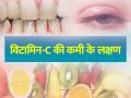 विटामिन-सी की कमी के लक्षण, ये 5 चीजें करेंगी विटामिन-सी की कमी को दूर - Hindi News | Signs of Vitamin C Deficiency bleeding gums weakness fatigue and rash | Latest health Photos at Lokmatnews.in
