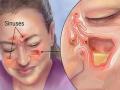 How to get rid sinus: साइनस का घरेलू उपचार, नाक में जमे कफ और दर्द से जल्दी राहत पाने के लिए आजमायें ये 5 घरेलू उपाय - Hindi News | How to get rid sinus : signs and symptoms of Sinusitis or sinus infection, home remedies and medical treatment of sinus infection, home remedies and food list for sinus infection in Hindi | Latest health News at Lokmatnews.in