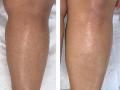 Strawberry Legs treatment: पैरों पर बालों की जड़ो में दिखने वाले बड़े छिद्रों और काले धब्बों से इन 3 आसान तरीकों से पाएं छुटकारा - Hindi News | Strawberry Legs Treatment, Symptoms, Causes, home remedies, cream and Laser therapy in Hindi | Latest health News at Lokmatnews.in