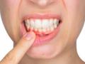 दांत और मसूड़े खराब होने का ये अजीब कारण आपको कर देगा हैरान - Hindi News | Genes may play role in tooth decay, gum disease: Study | Latest health News at Lokmatnews.in