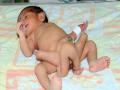 Parasitic Twin: एक ऐसा दुर्लभ विकार जिसमें 2 सिर, 8 हाथ-पैर के साथ पैदा होते हैं बच्चे, जानें कारण, लक्षण, इलाज - Hindi News | Parasitic Twin: Causes, Symptoms, risk factors, Diagnosis, treatment, types, cases, meaning, images, cases in India, Head, Tumor and Definition in Hindi | Latest health News at Lokmatnews.in
