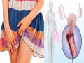 Vaginal Health Tips: बारिश में यीस्ट इन्फेक्शन के दर्द, स्मेल, डिस्चार्ज से बचाएंगे ये 8 उपाय - Hindi News | Vaginal Health Tips: vaginal yeast infection in monsoon, know causes, symptoms, treatment, home remedies, medicine, cream, prevention and risk factors in Hindi | Latest health News at Lokmatnews.in