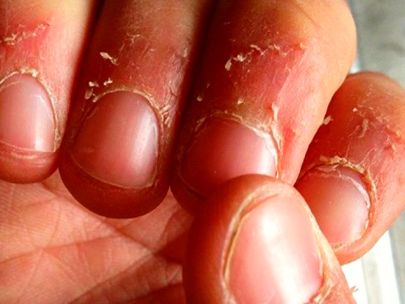 Health care: जानें नाखून पर दिखने वाले सफेद निशान के पीछे की वजह, ऐसे करें  बचाव | know the reasons of white spots on nails, follow these health care  tips in Hindi |