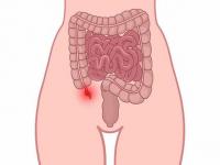 Appendicitis असहन य ह त ह प ट म अप ड क स फटन क दर द 8 लक षण स कर पहच न य 10 च ज द ल ए ग र हत