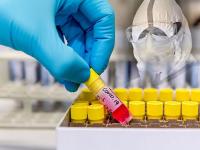 Coronavirus News: इन देशों में कोरोना का सबसे ज्यादा प्रकोप, लाखों में पहुंची मरीजों की संख्या - | coronavirus news positive cases in america spain russia italy france live updates coronavirus covid-19 | Latest india Photos at Lokmatnews.in