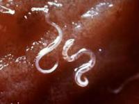 Video: 14 साल के बच्चे का 22 लीटर खून पी गया कीड़ा, डॉक्टर भी हैरान