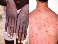 Monkeypox: देश में मंकीपॉक्स के 27 मामलों की पुष्टि हुई, पढ़ें पूरी खबर - | 27 Monkeypox Cases Reported In India Till July 24 | Latest health Photos at Lokmatnews.in