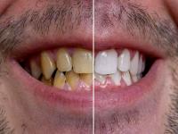 दांतों का पीलापन होगा दूर,अपनाएं ये 5 उपाय, मिलेंगे सफेद और चमकते दांत - | Home remedies for teeth whitening get rid yellow teeth | Latest fashion-beauty Photos at Lokmatnews.in