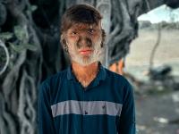 17 साल के ललित के पूरे शरीर और चेहरे पर उग आए बाल, दुनिया में केवल 50 लोगों को है ये दुर्लभ बीमारी - | 17-year-old Lalit with `werewolf syndrome` in Madhya Pradesh only 50 people in the world have this rare disease | Latest weird Photos at Lokmatnews.in