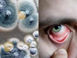 Can Non Covid Patients Get Black Fungus Here S What Experts Say English Lokmat Com