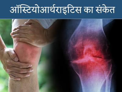 how long does it take to recover from vitamin d deficiency | how-long-does-it-take-to-recover-from-vitamin-d-deficiency | Latest health Photos at Lokmatnews.in how long does it take to recover from vitamin d deficiency | how-long-does-it-take-to-recover-from-vitamin-d-deficiency | Latest health Photos at Lokmatnews.in