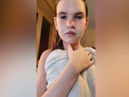 Trending viral news: 12 year old american girl daniel mccraven is allergic to water | अजब-गजब: शरीर पर पानी पड़ते ही जलने लगती है इस लड़की की स्किन, आंसू भी खुद के लिए जानलेवा