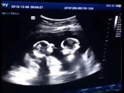 Identical twins spotted ‘fighting’ inside mother’s womb during ultrasound Watch viral video | मां के पेट के अंदर ही मुक्केबाजी कर बैठे दो जुड़वा बच्चे, वायरल हुआ VIDEO