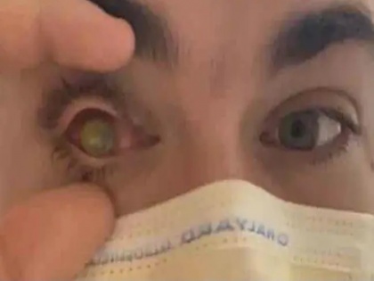 21-year-old America man slept only 40 minutes day wearing contact lenses pupil licked by flesh-eating parasites | अमेरिका: कॉन्टैक्ट लेंस पहनकर दिन में केवल 40 मिनट तक सो गया था 21 साल का युवक, आंख खुली तो लड़के की पुतली चट गए मांस खाने वाले जीव