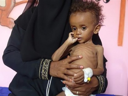 twenty million people are hungry in yemen | भूख से तड़प रहे हैं यमन के दो करोड़ लोग, ढाई लाख लोग कर रहे हैं तबाही और कुपोषण का सामना