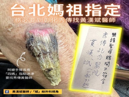 7 meter long rare fairy horn found in 91-year-old taiwan grandmother arm woman reached hospital treatment | फोटो: 91 साल की दादी के बांह में निकला 7 सेंटीमीटर लंबा सिंग, परेशान होकर इलाज के लिए अस्पताल पहुंची महिला