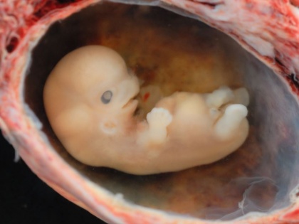 8 undeveloped fetuses stomach 21-day-old girl Rare case Jharkhand doctors claim world's first such case | झारखंड में सामने आया दुर्लभ मामला, 21 दिन की बच्ची के पेट से निकले 8 अविकसित भ्रूण, डॉक्टरों का दावा- दुनिया का पहला ऐसा केस