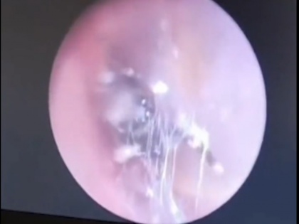 a live spider entered chinese woman ear started making fake eardrum doctors pulled it out watch horrifying video | चीन: महिला के कान में घुसी जिंदा मकड़ी और बनाने लगी नकली कान का पर्दा, डॉक्टरों ने ऐसा निकाला बाहर, देखें भयावह वीडियो