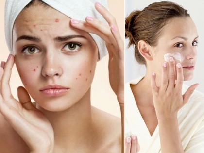 Skin Care Tips to deal with acne during monsoons | Skin Care Tips: मॉनसून में मुंहासों से हैं परेशान! स्किन को हेल्दी बनाने में काम आएंगे ये 4 टिप्स