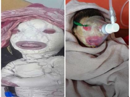 Madhya Pradesh: Alien-like child born in Rewa, doctors were shocked on seeing him | मध्य प्रदेश: रीवा में जन्मा एलियन जैसा बच्चा, देखते ही चौंक गए डॉक्टर