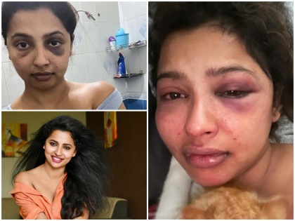 Anicka Vikraman accuses ex-boyfriend of assault shares picture with bruise under eye | अभिनेत्री अनिका ने सूजी आँख और शरीर पर काले चोट के निशान की शेयर की तस्वीरें, एक्स-बॉयफ्रेंड पर लगाया मारपीट का आरोप