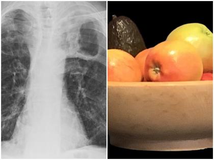 World TB Day 2022 Take care of yourself TB Day include these things daily routine body weakness will go away health news in hindi | World TB Day 2022: टीबी दिवस पर ऐसे रखें खुद का ख्याल, डेली रूटीन में शामिल करें इन चीजों को, यूं दूर हो जाएगी शरीर की कमजोरी