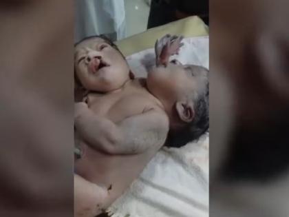 Woman gives birth to baby with two heads, three hands in Vidisha town in Bhopal | महिला ने 2 सिर, 3 हाथ और 4 पंजों वाले बच्चे को दिया जन्म, देखने के लिए हॉस्पिटल में लगी लाइन