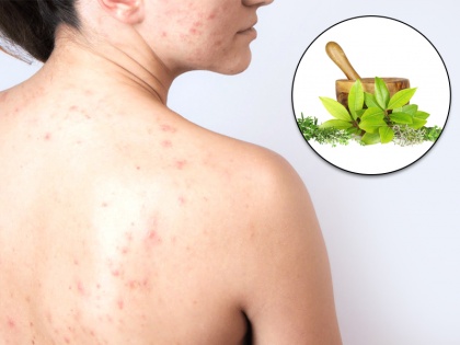 Easy home remedies to get rid of back acne in hindi | चेहरे से अलग होते हैं पीठ के मुंहासे, घर पर ही करें इनका देसी इलाज