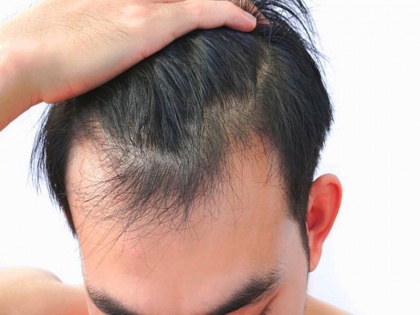 Hair fall and baldness treatment : 5 home remedies and Ayurveda herbs to get rid baldness and hair fall in Hindi | गंजेपन का घरेलू इलाज : झड़ते बाल और गंजेपन से छुटकारा पाने के 6 आयुर्वेदिक उपचार