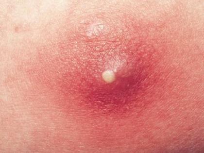 skin disease remedies : home remedies, medical treatment for Folliculitis or inflammation of hair follicles in Hindi | पस भरे दर्दनाक बालतोड़ को 2 दिन में सुखाकर रख देंगी ये 8 चीजें skin disease remedies : home remedies, medical treatment for Folliculitis or inflammation of hair follicles in Hindi | पस भरे दर्दनाक बालतोड़ को 2 दिन में सुखाकर रख देंगी ये 8 चीजें