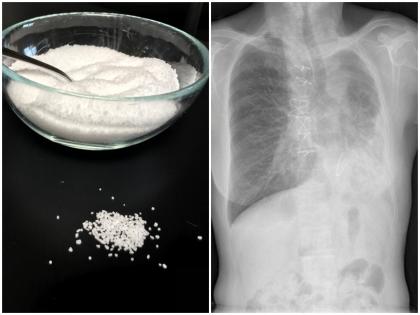 Do not eat too much salt in lung problems stay away from cabbage broccoli can be heavy damage to health tips in hindi | फेफड़ों की परेशानी में न खाएं ज्यादा नमक, गोभी और ब्रोकली से रहे दूर, वरना सेहत को हो सकता है भारी नुकसान