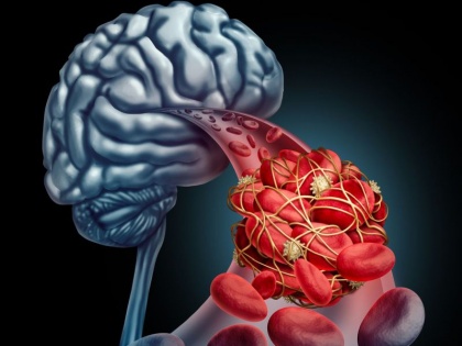 home treatment of blockage in brain: sign and symptoms of blockage in brain, home remedies for blockage in brain in Hindi | सिर की नसों में ब्लॉकेज का इलाज : जानिये दिमाग की नसों में सिकुड़न के लक्षण और ब्लॉक नसों के खोलने के 6 घरेलू उपाय