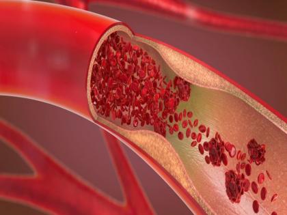 arterial plaque and clogged arteries: causes, symptoms, treatment in Hindi, nas block ke lakshan, pair aur dimag ki block naso ka ilaj, block nas kaise khole, band nason ko kholne ki dawa, ayurvedic and homeopathic ilaj | Nas block ke lakshan: नसों के ब्लॉक होने से पर मिलती हैं 5 चेतावनी, जानियें नसों को खोलने के 8 तरीके, डाइट प्लान
