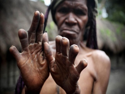 indonesia dani tribe where womens fingers cut after husband death | इस देश में पति के मरते ही पत्नी की काट दी जाती है उंगलियां, सजा के दर्दनाक तरीके जान कांप उठेगी रूह