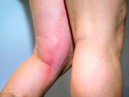 Deep Vein Thrombosis symptoms: 3 severe sign and symptoms of blood clot you can find in your legs | Deep Vein Thrombosis symptoms: आपके पैरों में जैम गए हैं खून के थक्के, इन 3 लक्षणों को देखकर पहचानें Deep Vein Thrombosis symptoms: 3 severe sign and symptoms of blood clot you can find in your legs | Deep Vein Thrombosis symptoms: आपके पैरों में जैम गए हैं खून के थक्के, इन 3 लक्षणों को देखकर पहचानें