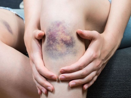 Bruise or Ecchymosis: causes, symptoms, risk factors, home remedies, natural remedies in Hindi | शरीर पर बेवजह नीले निशान पड़ते हैं? इस खतरनाक रोग का है संकेत, ये 3 उपाय दिलाएंगे राहत
