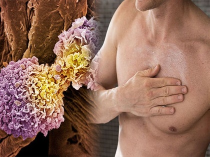 Breast Cancer in men: breast cancer symptoms in men, cause, medical treatment and prevention tips in Hindi | Breast Cancer in men: पुरुषों में ब्रेस्ट कैंसर के 5 लक्षण, जानिये कारण और किसे है ज्यादा खतरा