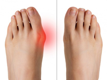 Bunion pain relief home remedies: 8 best and effective ways to ease Bunion Pain Naturally | Bunion pain relief home remedies: पैर के अंगूठे और पंजों के दर्द के लिए 6 असरदार घरेलू उपाय