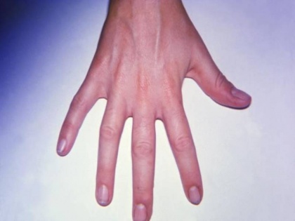 Can cracking of fingers cause arthritis Revealed in the study | क्या उंगलियां चटकाने से हो सकता है गठिया? अध्ययन में हुआ खुलासा
