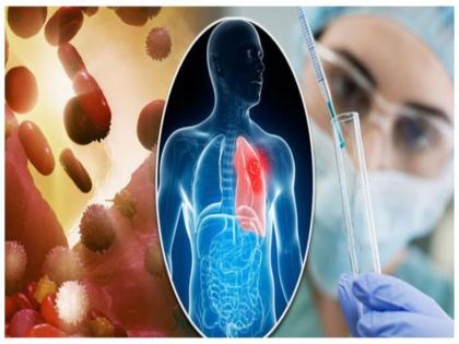 Cancer In India 26 percent patients tumor cancer in head and neck research 1869 patients what reason for this? | Cancer In India: खैनी और तंबाकू जल्द छोड़ो, 26 प्रतिशत मरीजों को सिर और गर्दन में ट्यूमर कैंसर, 1869 पर रिसर्च
