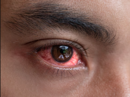 Conjunctivitis special care of eyes during monsoon know symptoms eye infection | Conjunctivitis: मानसून के मौसम में आंखों का रखें खास ध्यान, जानिए कंजंक्टिवाइटिस के लक्षण और बचने के तरीके