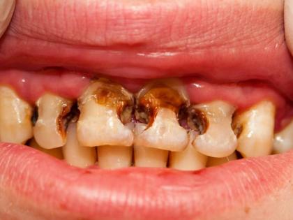 cavity home treatment in Hindi : Ayurvedic treatment for cavity, use these 7 foods and herbs to get rid cavity | दांत के कीड़े का घरेलू उपचार : दांत के कीड़े का देसी इलाज करने के लिए आजमायें 7 घरेलू उपाय cavity home treatment in Hindi : Ayurvedic treatment for cavity, use these 7 foods and herbs to get rid cavity | दांत के कीड़े का घरेलू उपचार : दांत के कीड़े का देसी इलाज करने के लिए आजमायें 7 घरेलू उपाय