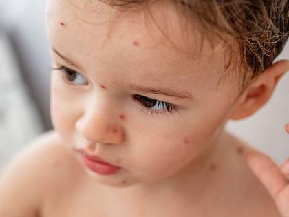 Chickenpox signs and symptoms, causes and treatment, prevention tips and risk factors in Hindi, chechak ka ilaj, chechak ke gharlu upay, chechak treatment, chechak ka tika in Hindi | Chickenpox ka ilaj: चेचक का घरेलू उपचार, चेचक के दाग की दवा, चेचक होने पर क्या करें क्या नहीं, चेचक में क्या खायें, जानिये सब कुछ
