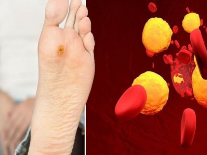cholesterol symptoms in Hindi: according researcher you can found a critical symptom of high cholesterol condition in your feet | Cholesterol symptoms: पैरों में नजर आ सकता है हाई कोलेस्ट्रॉल का नया गंभीर लक्षण, समझें और बचाव करें